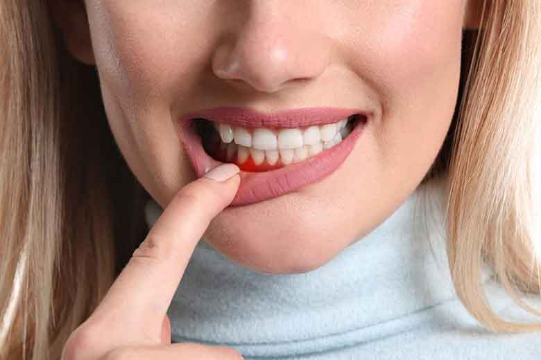 Gum Recession treatment